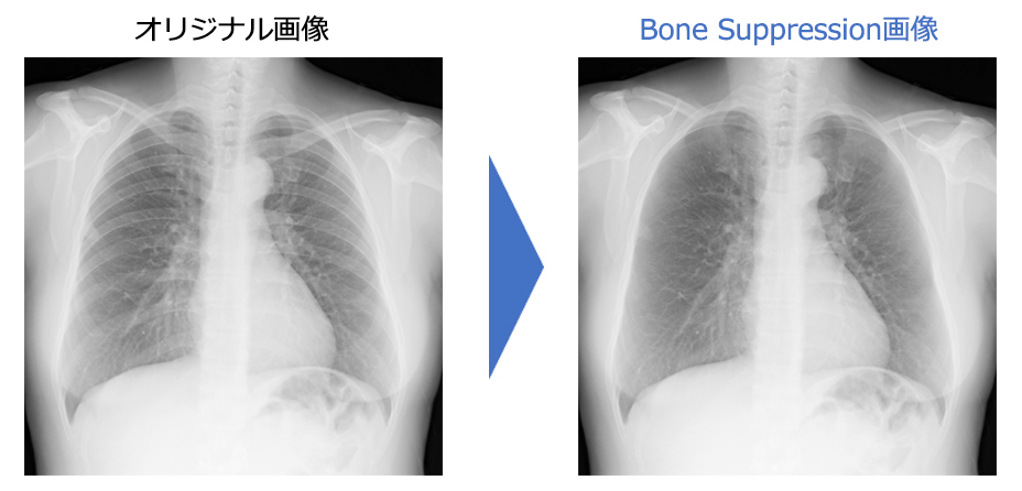 Bone Suppression処理（胸部骨減弱処理） | コニカミノルタ