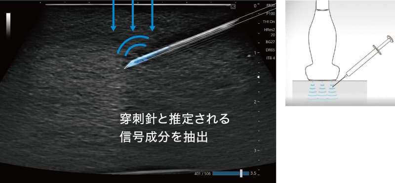 穿刺の精度向上をサポート SNV（Simple Needle Visualization）